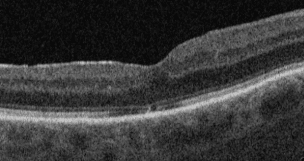 Macular Hole I Mr Ellabban Eye Surgery | Yorkshire & Hull