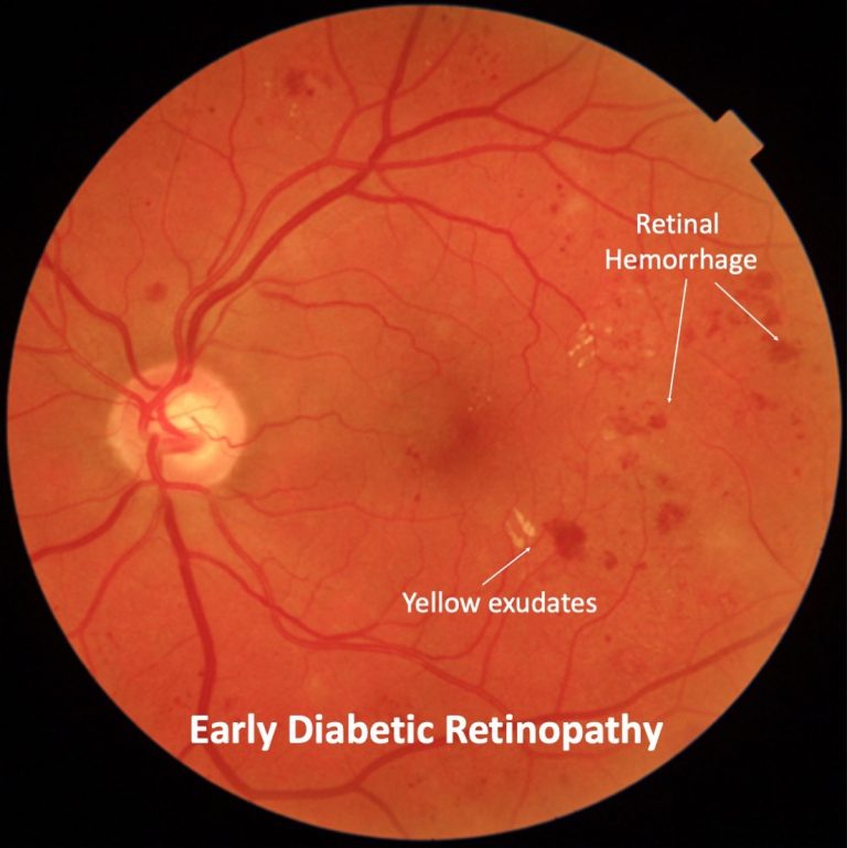 Diabetic Retinopathy Mr Ellabban Eye Surgery Yorkshire And Hull