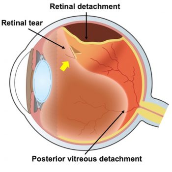 Posterior Vitreous Detachment I Mr Ellabban | Yorkshire & Hull