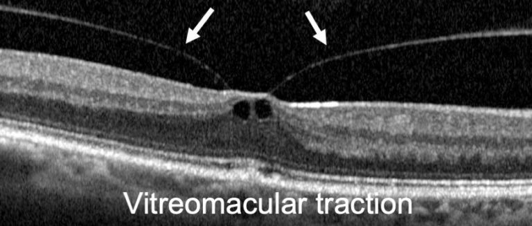 Vitreomacular Traction I Mr Ellabban Eye Surgery | Yorkshire & Hull