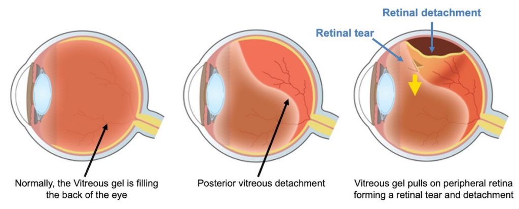 symptoms of detached retina